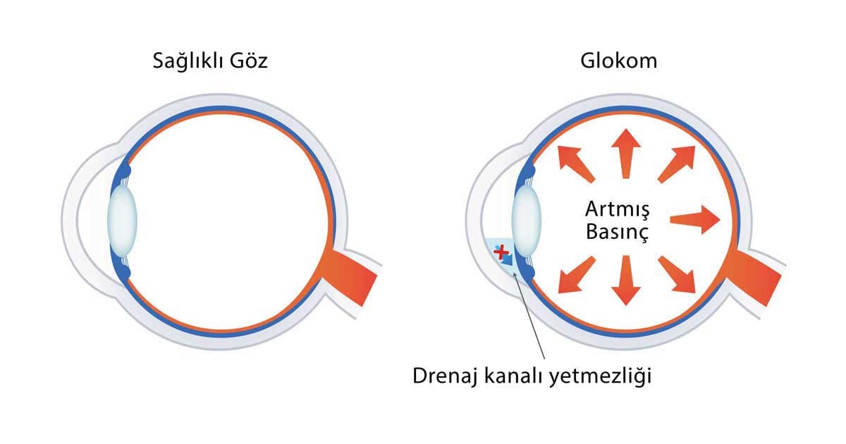 Angle-closure glaucoma illustration