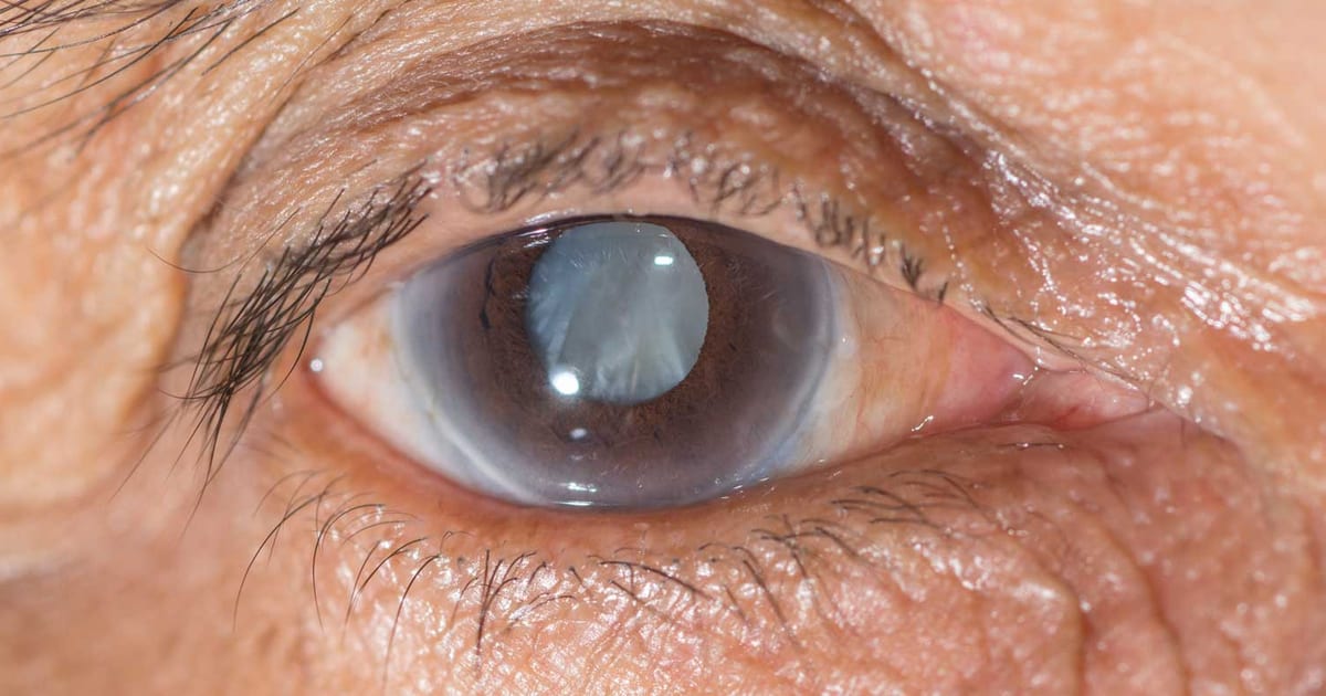 Cataract — clouding of the eye's natural lens