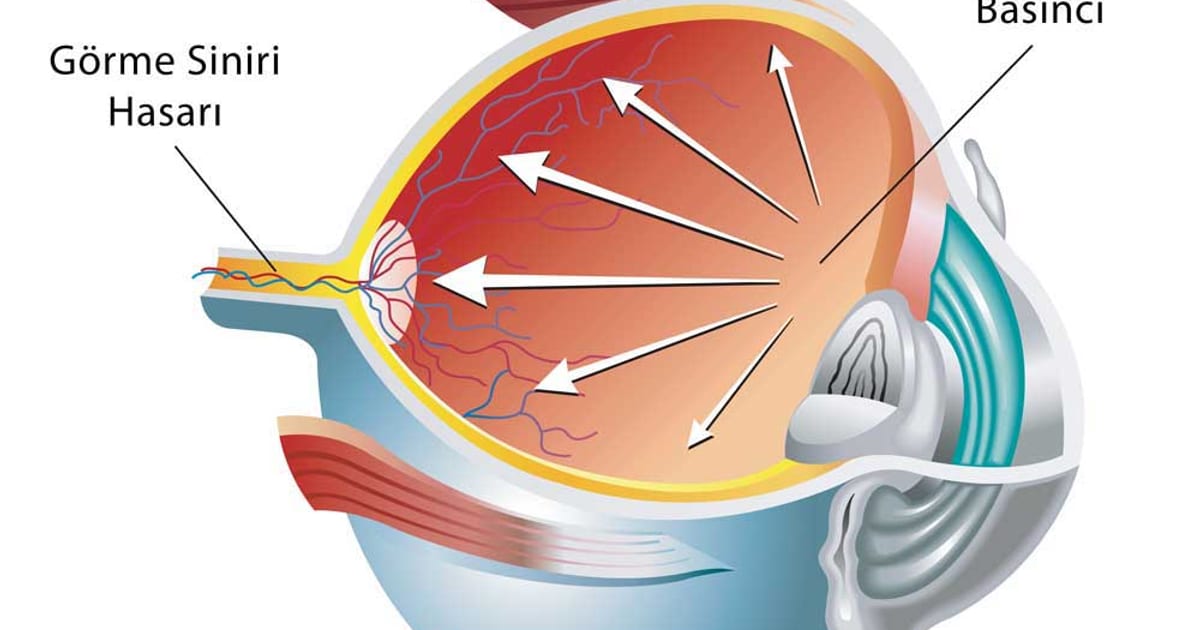 Glaucoma and raised intraocular eye pressure